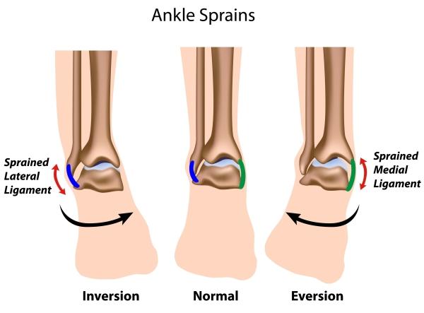 Ankle Ligament Sprains