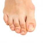 Mild Bunion