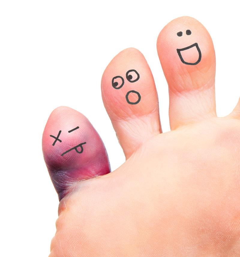 Chilblains