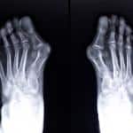 X- Ray of a Bunion